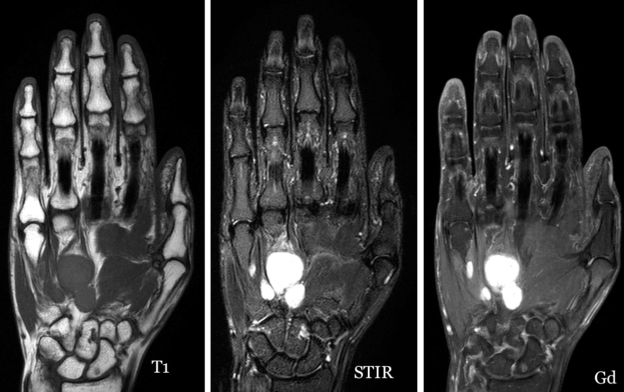 Figure 4 for case Plexiform schwannoma ( RID4480 )